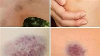 اعراض تدل على وجود جلطه بجسمك