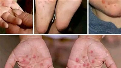 فيروس جديد يسبب ظهور الحبوب على جسم الاطفال 