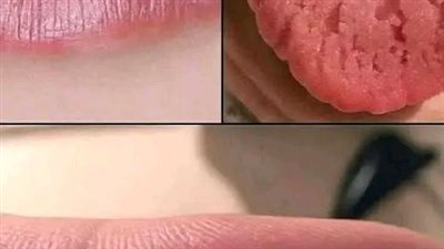 تشققات اللسان علامات لأمراض خطيره